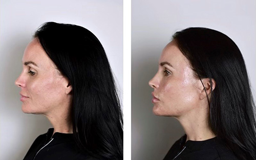 PRP Bio-filler Ashland KY - Before & After Treatment
